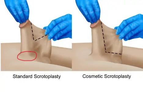 scrotoplasty-versions